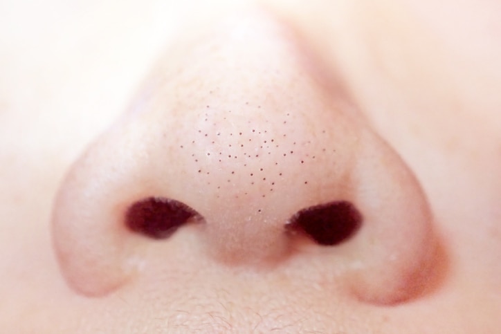 close up macro of many acne small blackhead pimples on the nose