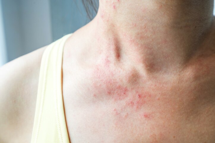 Young woman has skin rash itch on neck