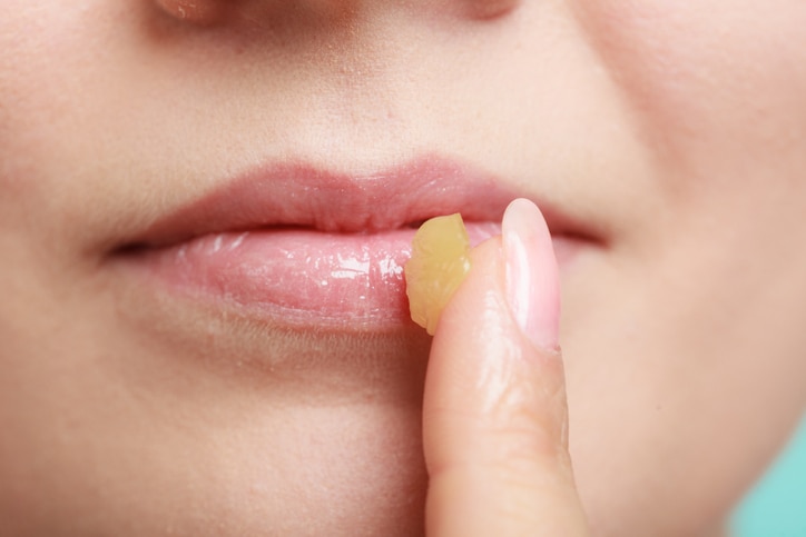 Female putting applying lip balm moisturizing balsam. Girl taking care of lips. Skincare.