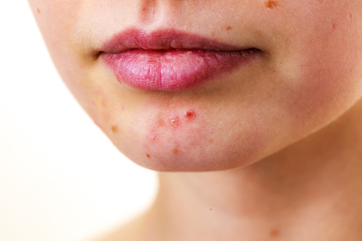 Young woman showing her face with acne and moles, dry lips. Teen girl no make up with red spots on her chin. Health problem, skin diseases.