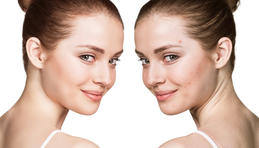 How to Choose Toner for Your Skin Type - Target 1 No Acne