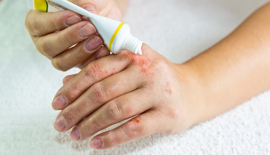 how to get rid of eczema