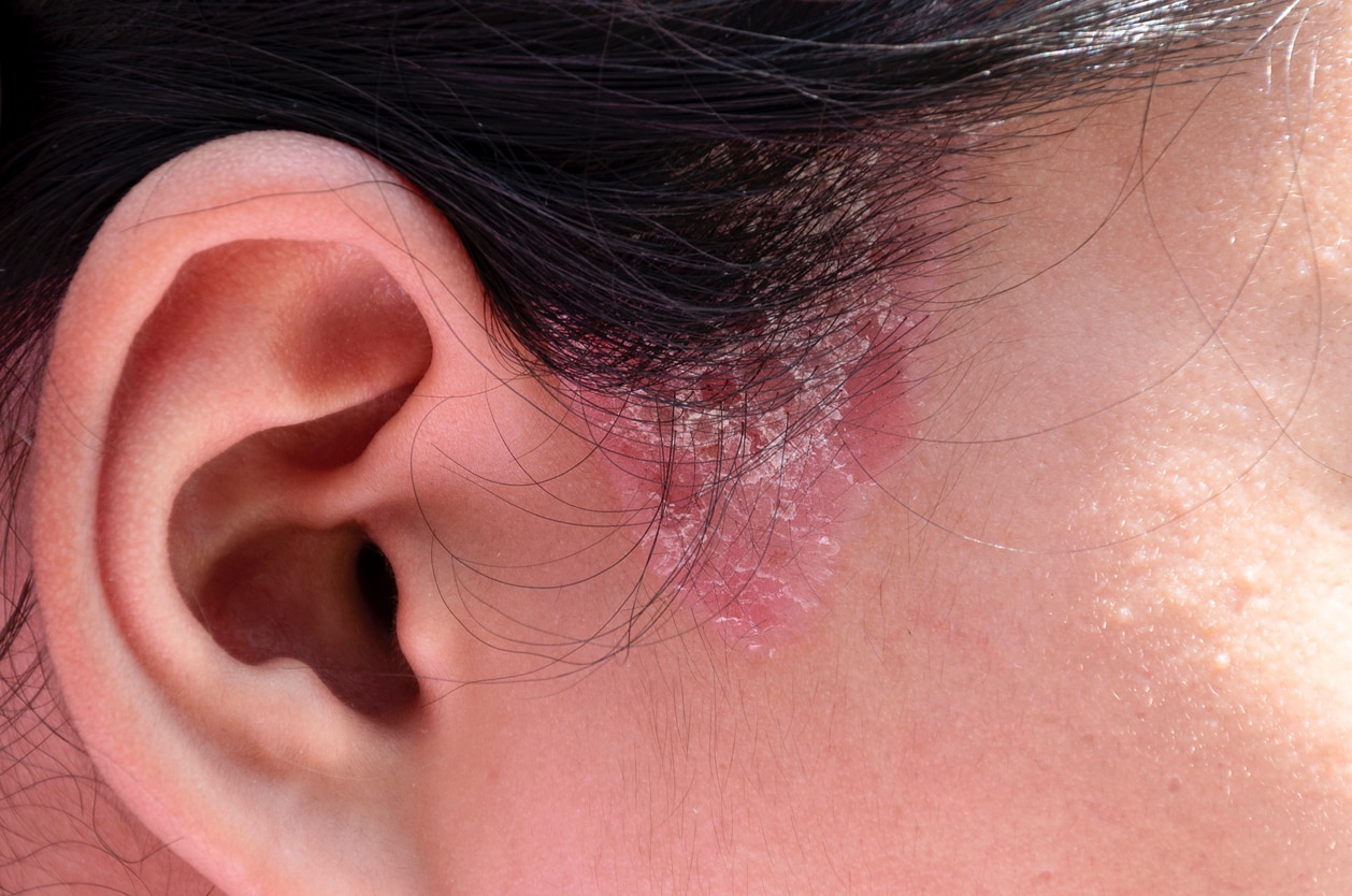 Scalp Psoriasis: Causes, Symptoms And Treatment | Watsons Singapore